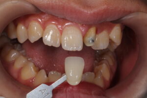 歯科技工士シェード